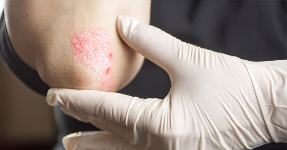 psoriaz